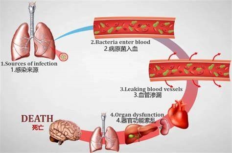 大S死因改为败血症：和肺炎关系密切 死亡率可达60％！